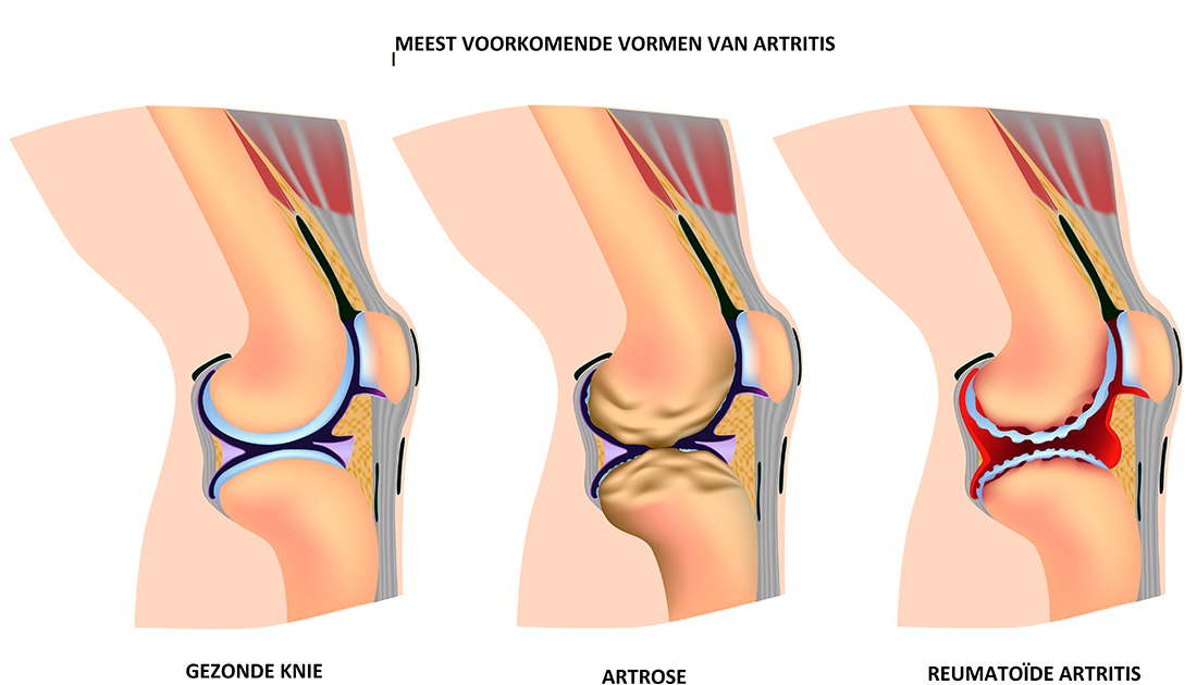 Verschil tussen een gezonde knie, knie osteoartritis en reumatoïde artritis knie.