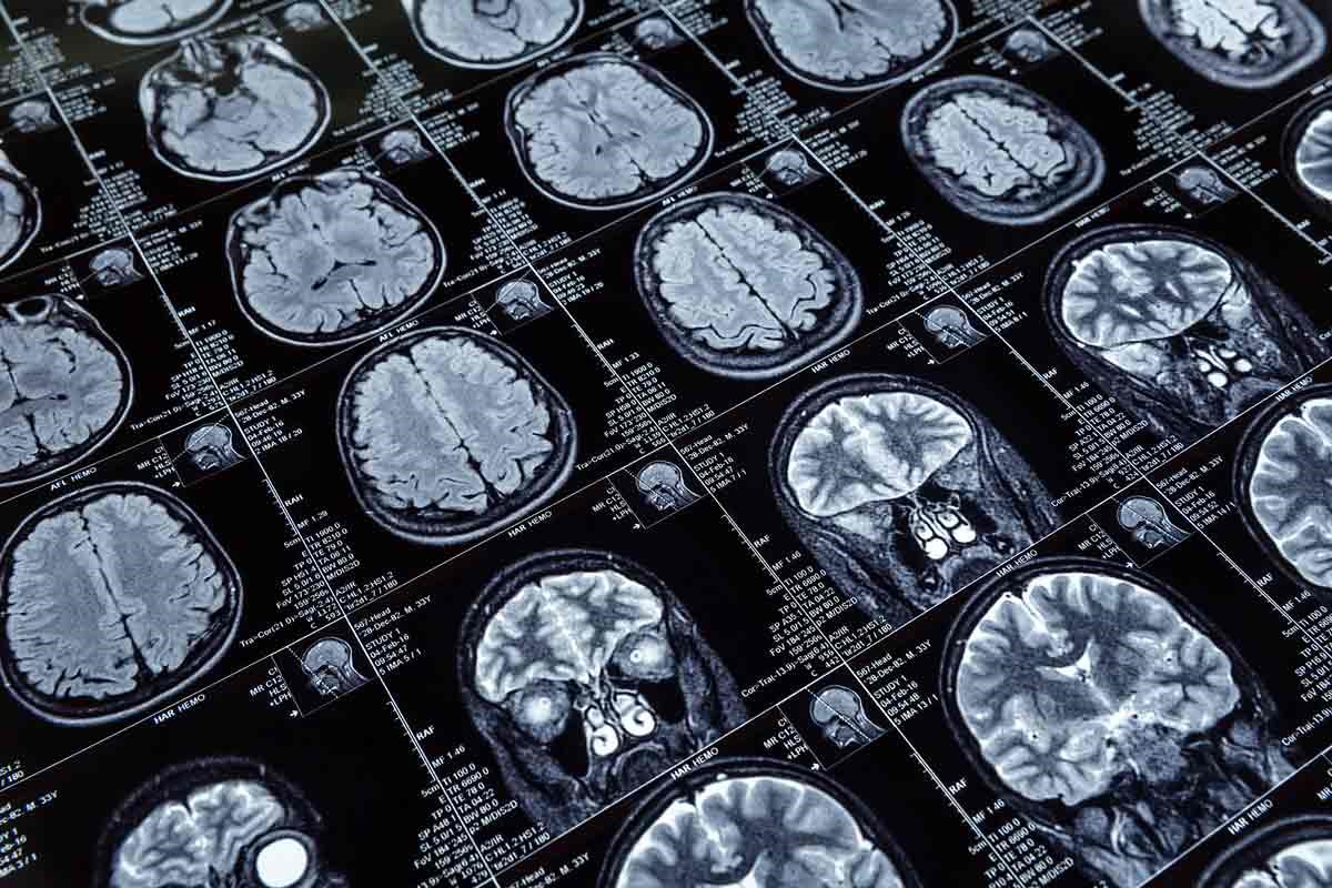 Topografie van de hersenen bij de ziekte van Alzheimer 